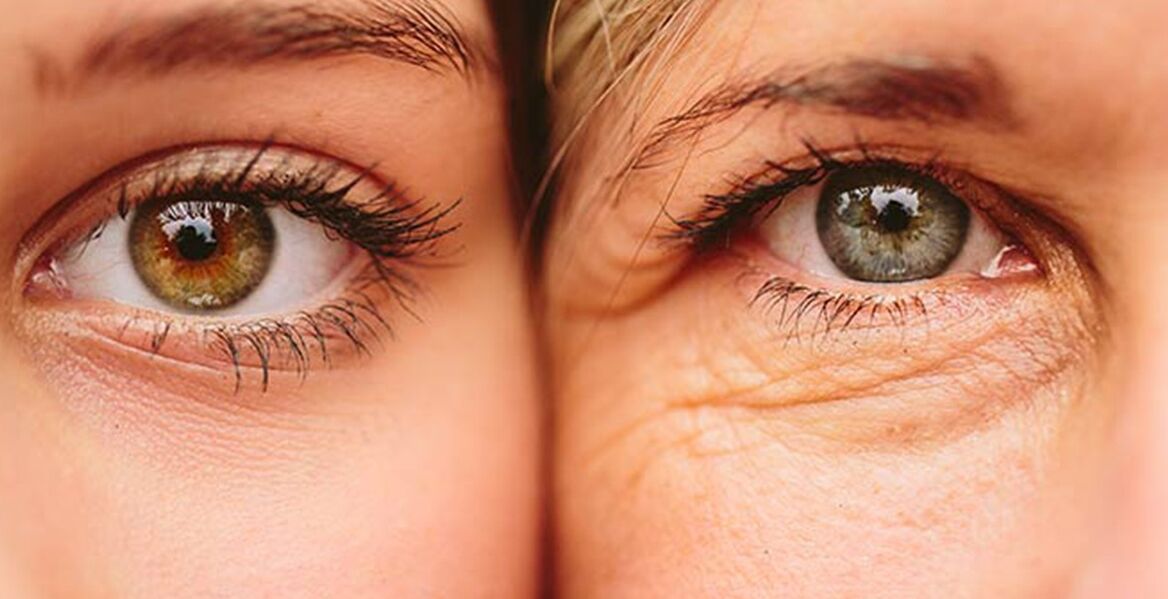 Signos externos de envejecimiento de la piel alrededor de los ojos en dos mujeres de diferentes edades