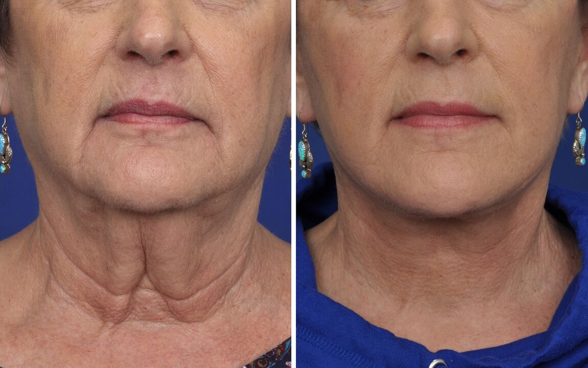 antes y después de los procedimientos de rejuvenecimiento de la piel