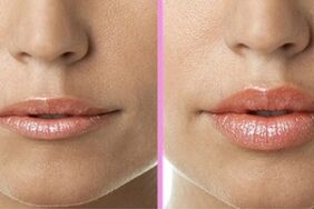 antes y después del procedimiento de restauración de labios